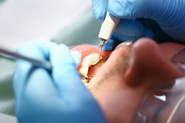 Best Emergency Root Canal Therapy in Honeygo, MD